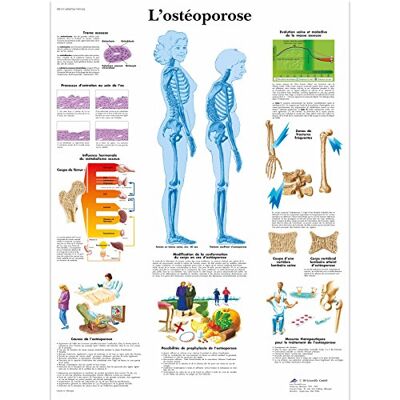 3B Scientific Osteoporosi Tavola Didattica Anatomica su Carta, Multicolore, 50 x 67 cm 3B Scientific Osteoporosi Tavola Didattica Anatomica su Carta, Multicolore, 50 x 67 cm
