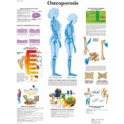 3B Scientific VR3121UU Stampato su carta, Osteoporosi 3B Scientific VR3121UU Stampato su carta, Osteoporosi