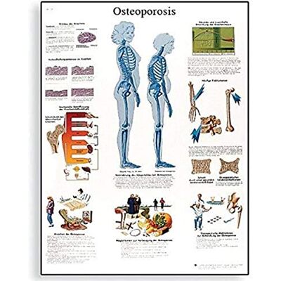 3B Scientific Tabella 3B Osteoporosis Scientific 3B Scientific Tabella 3B Osteoporosis Scientific
