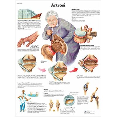 3B Scientific VR4123UU Artrosi 3B Scientific VR4123UU Artrosi