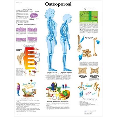 3B Scientific VR4121UU Osteoporosi 3B Scientific VR4121UU Osteoporosi