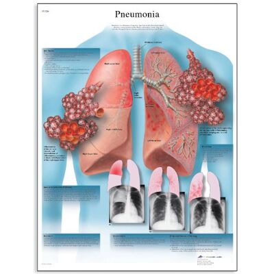 3B Scientific polmonite Chart, unlaminated 3B Scientific polmonite Chart, unlaminated