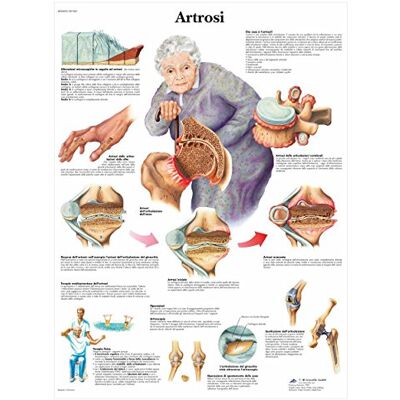 3B Scientific VR4123L Artrosi - Poster educativo 3B Scientific VR4123L Artrosi - Poster educativo