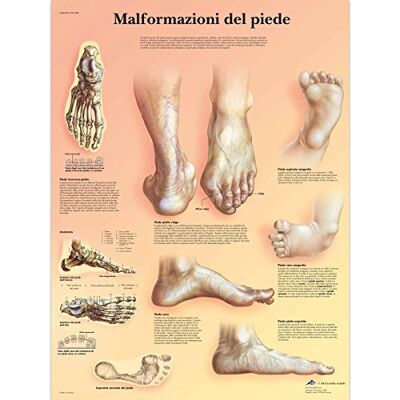 3B Scientific VR4185UU Malformazioni di Piede 3B Scientific VR4185UU Malformazioni di Piede