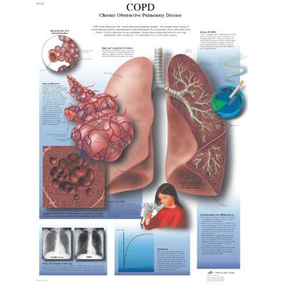 3B Scientific Cronica Ostruttiva Grafico, Laminated, 1 3B Scientific Cronica Ostruttiva Grafico, Laminated, 1