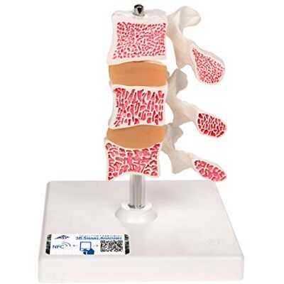 3B Scientific Osteoporosi, Modello di Lusso + software gratuito di anatomia 3B Smart Anatomy 3B Scientific Osteoporosi, Modello di Lusso + software gratuito di anatomia 3B Smart Anatomy