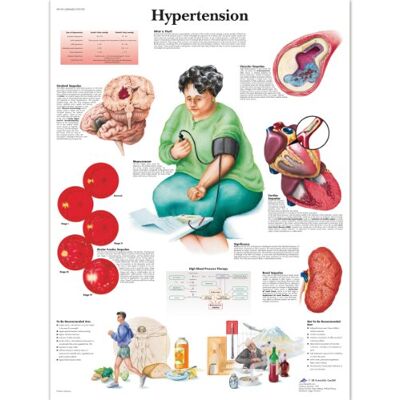 3B Scientific Anatomia umana scientifica 3B, Grafico ipertensione, versione laminata 3B Scientific Anatomia umana scientifica 3B, Grafico ipertensione, versione laminata