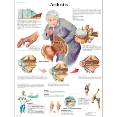 3B Scientific Anatomia umana Grafico dell'artrite, versione laminata 3B Scientific Anatomia umana Grafico dell'artrite, versione laminata