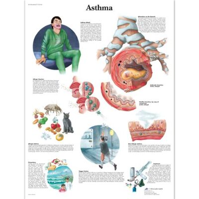 3B Scientific Anatomia umana scientifica 3B, Grafico di asma, versione laminata 3B Scientific Anatomia umana scientifica 3B, Grafico di asma, versione laminata