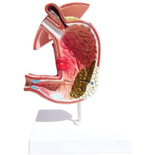 MUSUMI Medische Modellen, Maag Anatomie Model Gastritis Model Maag Laesie Model Maag Ziekten Demonstratie Menselijk Spijsverteringsstelsel Anatomisch Model