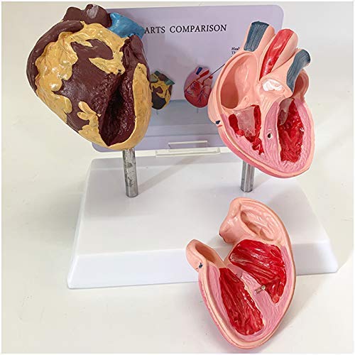 MUSUMI Educatief Model Menselijk Hart Model Menselijk Orgaan Anatomie Model Pathologisch Hart Anatomisch Model Gezond En Roken Mensen Hart Vergelijkend Model