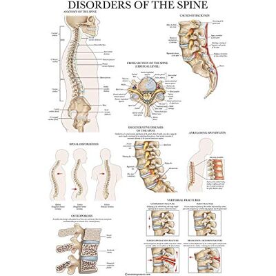 Palace Learning Aandoeningen van de wervelkolom anatomie poster gelamineerde spinale aandoeningen anatomische kaart 18 "x 27 Palace Learning Aandoeningen van de wervelkolom anatomie poster gelamineerde spinale aandoeningen anatomische kaart 18 "x 27