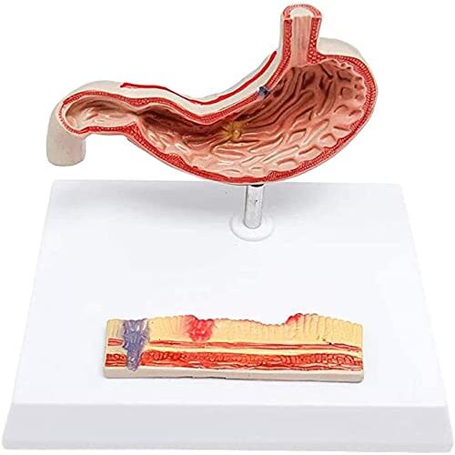dsmsdre Anatomiemodel Maagzweer Anatomiemodel Maaganatomiemodel Medisch anatomisch maagziek model Anatomisch model van menselijk orgaan Compatibel met