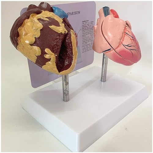 WlP Menselijk Rokend Hart En Gezond Hart Vergelijkingsmodel Pathologisch Longmodel Patiënthart Anatomie Vergelijkingsmodel Van Rokend Hart En Normaal Hart For Medische Leermiddelen
