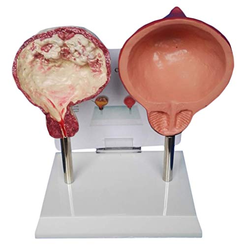FLYIFE Educatief model Medisch blaasmodel een vergelijkend model van rokende blaas en normale blaas anatomisch model van menselijk orgaan