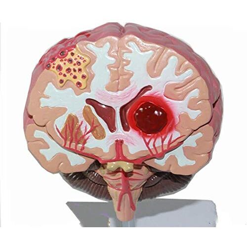 BENPCRD Hersenstructuur Anatomie Model Neurologie Medisch Leermiddel Hersenslag Pathologie Model