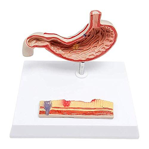 MUSUMI Maagzweer Anatomie Model Maag Anatomie Model Medische Anatomische Maag Zieke Model Menselijk Orgaan Anatomisch Model voor Medisch Onderwijs