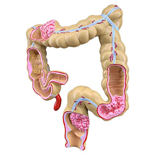 SmPinnaA Menselijk Colorectaal Laesiemodel Anatomiemodel Van Menselijk Orgaan Pathologisch Anatomisch Model Van Colorectale Ziekte Pvc-Materiaal Pathologische Anatomie Darmziekten Darmmodel