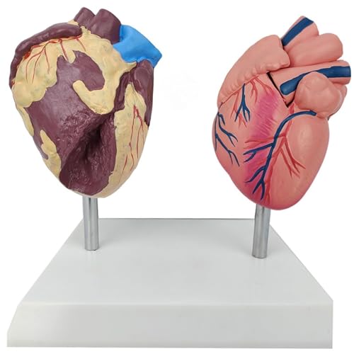 WlP Vergelijkend Model Van Gezond Hart En Roken Pathologisch Hart-Pathologisch Hart Anatomisch Model For Arts Patiënt Communicatiehulpmiddel Menselijke Anatomie En Fysiologie Onderwijs