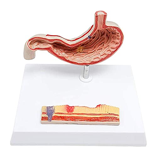 HKFJSH Maagzweer Anatomie Model Maag Anatomie Model Anatomisch Maag Ziek Model Menselijk Orgaan Anatomisch Model voor Studie Onderwijs voor Onderwijs