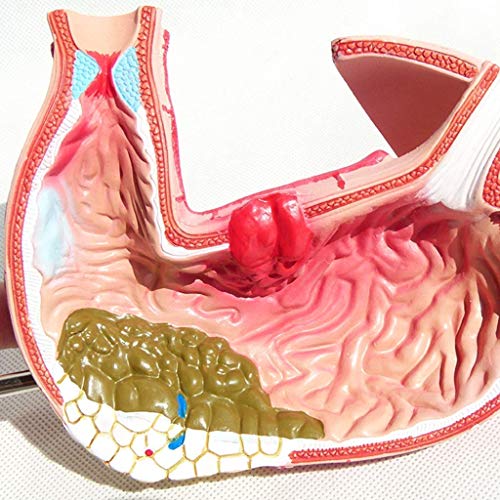 KJSHXYG Maag Anatomie Model Gastritis Model Maag Laesie Model-Maag Ziekten Demonstratie Menselijk Spijsverteringsstelsel Medisch Onderwijs Anatomisch Model