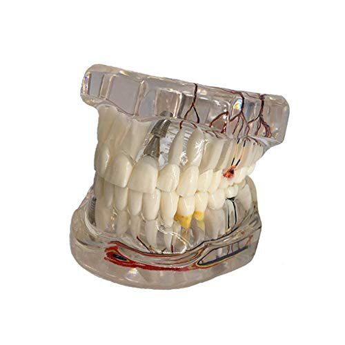 FGA Educatief Model Tandheelkundige Ziekten Implant Tanden Model met Herstelbrug Tandarts voor Medische Wetenschap Ziekte Onderwijs Studie