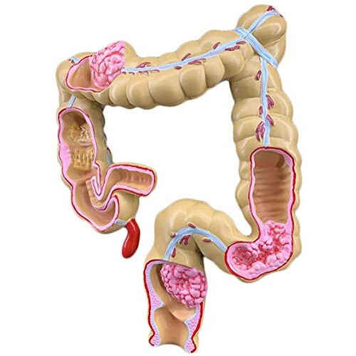 HYCLAM Medische modellen, menselijk colorectaal laesiemodel, pathologisch anatomisch model van colorectale ziekte, pathologische anatomie colonziekten darmmodel