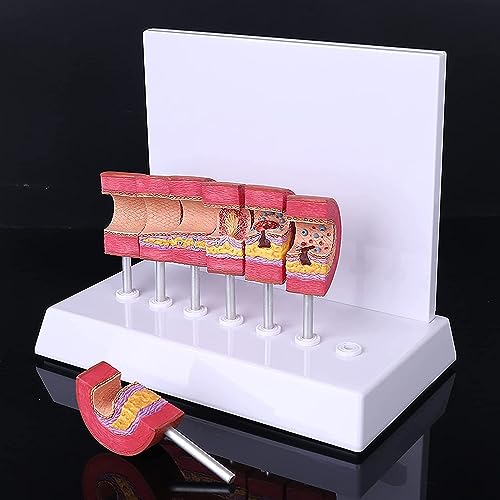 CHWLMP 3D Menselijk Orgaan Model, Menselijke Atherosclerose Cardiovasculaire Model Bloedvat Anatomisch Model Medische Onderwijsbenodigdheden
