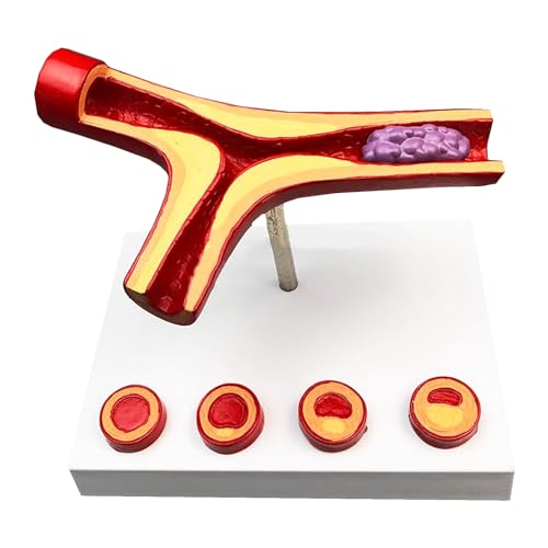 LKYLVEE Sclerose en trombosemodel, menselijk bloedvatmodel, pathologische vasculaire anatomie mal voor cardiovasculaire slagader coronaire slagader-achtige educatieve tool (B)