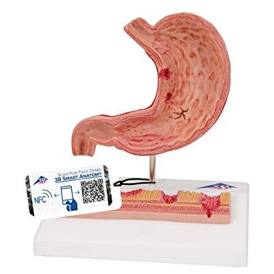 3B Scientific K17 Modelo de anatomia humana estômago com úlceras gástricas app de anatomia gratuita 3B Smart Anatomy 3B Scientific K17 Modelo de anatomia humana estômago com úlceras gástricas app de anatomia gratuita 3B Smart Anatomy