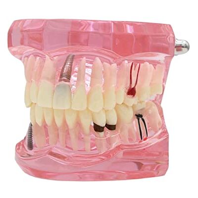 Dentalmall 1 st tandimplantat studie analys demonstration tänder modell #2001 med restaurering rosa Dentalmall 1 st tandimplantat studie analys demonstration tänder modell #2001 med restaurering rosa