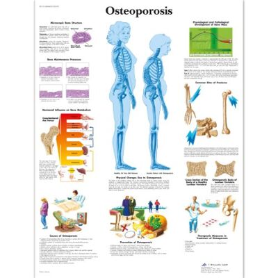 3B Scientific Vetenskaplig osteoporosdiagram, laminated, 1 3B Scientific Vetenskaplig osteoporosdiagram, laminated, 1