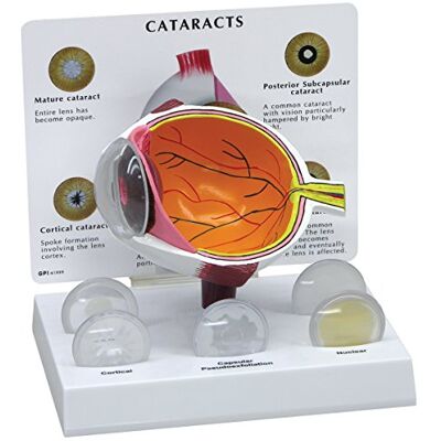 3B Scientific GPI Anatomicals Kataraktöga 3B Scientific GPI Anatomicals Kataraktöga