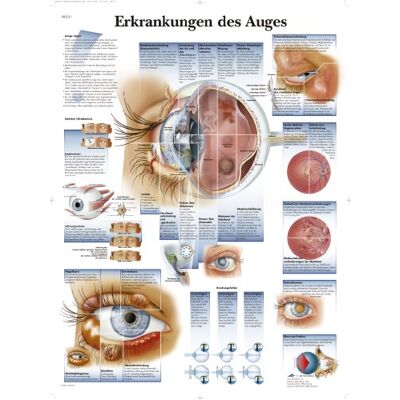 3B Scientific Lehtrafel – onemocnění okolí, VR0231UU 3B Scientific Lehtrafel – onemocnění okolí, VR0231UU