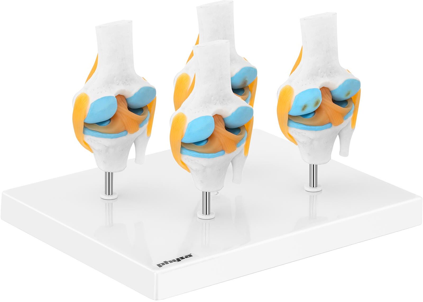 physa Knee Model - 4 stages Arthrosis - half yardstick PHY-KJ-3 physa Knee Model - 4 stages Arthrosis - half yardstick PHY-KJ-3