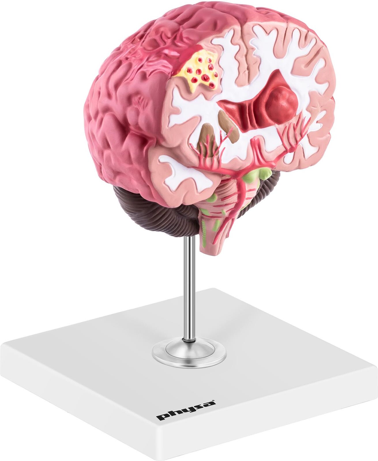 physa Brain Model - pathological - full-colour PHY-BM2 physa Brain Model - pathological - full-colour PHY-BM2
