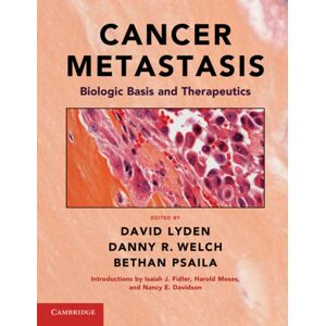 Cambridge University Press Cancer Metastasis : Biologic Basis And Therapeutics Cambridge University Press Cancer Metastasis : Biologic Basis And Therapeutics