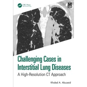 Taylor & Francis Ltd Challenging Cases In Interstitial Lung Diseases : A High-Resolution Ct Approach Taylor & Francis Ltd Challenging Cases In Interstitial Lung Diseases : A High-Resolution Ct Approach