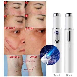 Unbranded Blue Light Therapy Pen For Spider Veins Acne Removal Pen Scar Wrinkles Puffy Eye Unbranded Blue Light Therapy Pen For Spider Veins Acne Removal Pen Scar Wrinkles Puffy Eye