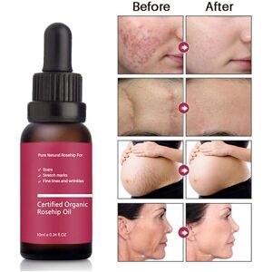 Unbranded 10ml Rosehip Seed Oil Cold Pressed Moisturizer for Dry Skin Unbranded 10ml Rosehip Seed Oil Cold Pressed Moisturizer for Dry Skin