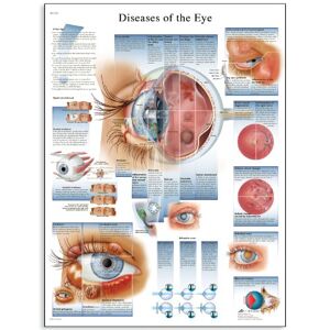 3B Scientific VR1231UU Human Anatomy Diseases of the Eye Chart, Paper Version, unlaminated 3B Scientific VR1231UU Human Anatomy Diseases of the Eye Chart, Paper Version, unlaminated