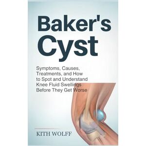 Wolff, Kith Baker’s Cyst: Symptoms, Causes, Treatments, and How to Spot and Understand Knee Fluid Swellings Before They Get Worse Wolff, Kith Baker’s Cyst: Symptoms, Causes, Treatments, and How to Spot and Understand Knee Fluid Swellings Before They Get Worse