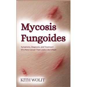 Wolff, Kith Mycosis Fungoides: Symptoms, Diagnosis, and Treatment of a Rare Cancer That Looks Like a Rash Wolff, Kith Mycosis Fungoides: Symptoms, Diagnosis, and Treatment of a Rare Cancer That Looks Like a Rash
