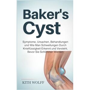 Wolff, Kith Baker’s Cyst: Symptome, Ursachen, Behandlungen und wie man Schwellungen durch Knieflüssigkeit erkennt und versteht, bevor sie schlimmer werden Wolff, Kith Baker’s Cyst: Symptome, Ursachen, Behandlungen und wie man Schwellungen durch Knieflüssigkeit erkennt und versteht, bevor sie schlimmer werden
