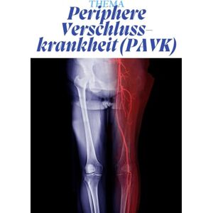 Pflegeleicht, Nadine Periphere Verschlusskrankheit (PAVK) – Kompaktwissen für Pflege-Auszubildende: Alles Wichtige verständlich erklärt – von Ursachen und Symptomen bis zu ... Pflege – Die Kittelbuch-Reihe“) Pflegeleicht, Nadine Periphere Verschlusskrankheit (PAVK) – Kompaktwissen für Pflege-Auszubildende: Alles Wichtige verständlich erklärt – von Ursachen und Symptomen bis zu ... Pflege – Die Kittelbuch-Reihe“)