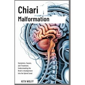 Wolff, Kith Chiari Malformation: Symptoms, Causes, and Treatment, Understanding the Brain’s Misalignment into the Spinal Canal Wolff, Kith Chiari Malformation: Symptoms, Causes, and Treatment, Understanding the Brain’s Misalignment into the Spinal Canal
