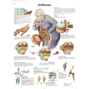 3B Scientific calibrer posters – Arthrose - affiche éducative - Publicité 3B Scientific calibrer posters – Arthrose - affiche éducative - Publicité
