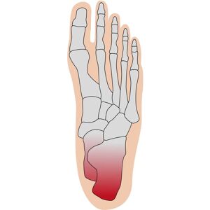 Dr. Hundt Fersenschutzbandage - Fersenbandage Dr. Hundt Fersenschutzbandage - Fersenbandage